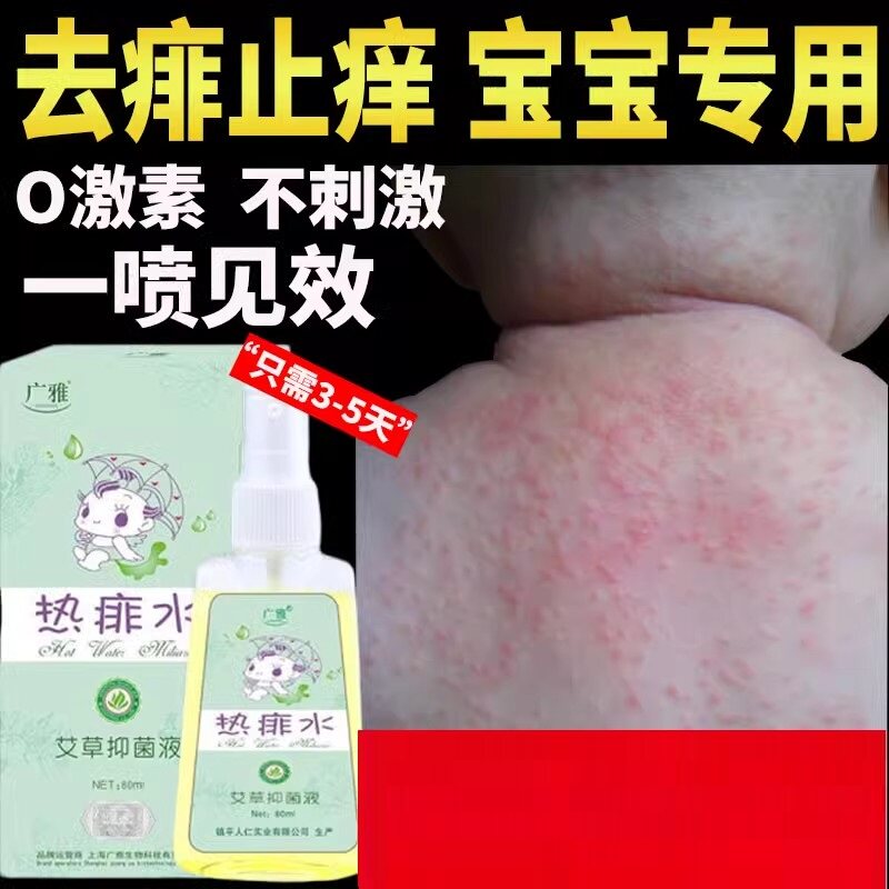 痱子止痒水宝宝婴儿专用去痱子喷雾祛痱膏防热痱子水儿童神器消除