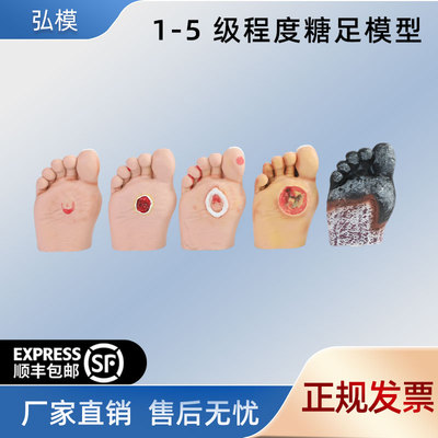 高级糖尿病足病理示教模型
