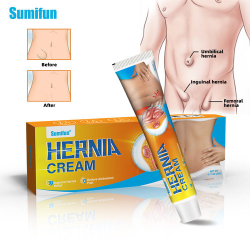 SumifuTemuHerniaExternal
