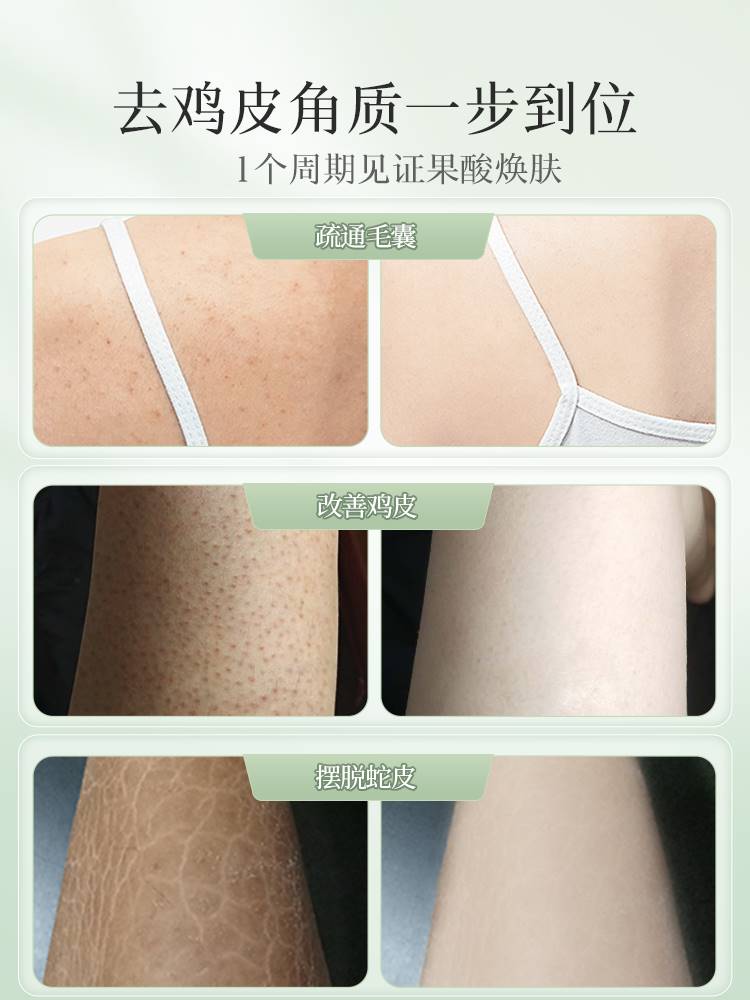 果酸身体乳去鸡皮肤疙瘩毛囊角化角质鱼鳞霜病干燥起皮去除神器