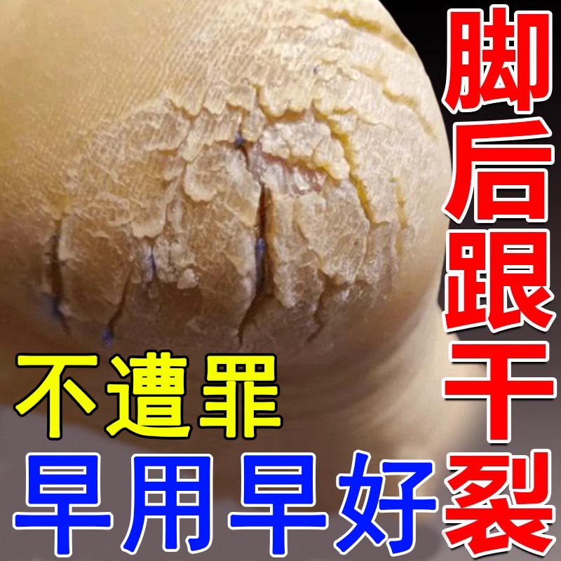脚后跟干裂手足滋润膏防裂皲裂
