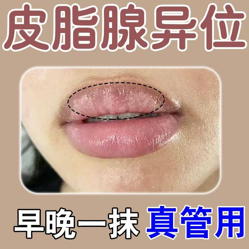 皮脂腺异位嘴唇干裂起泡润唇膏唇部长脂肪粒小白点嘴巴暗沉脱皮