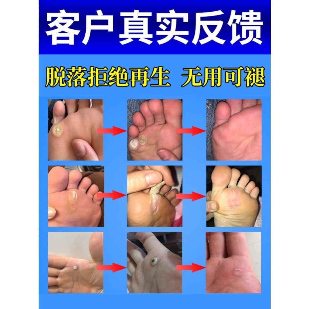 得了鸡眼怎么办治脚上长硬疙瘩肉刺膏脚底跖疣除足部克星贴专用药