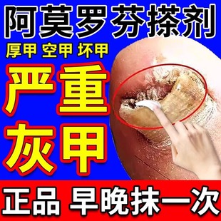 香港大药房盐酸阿莫洛芬搽剂灰指甲净亮甲罗芬乳膏官方正品旗舰店