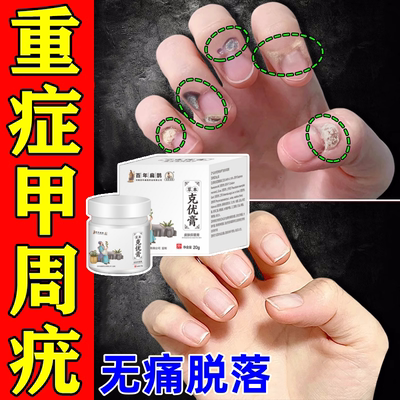 甲周疣专用药膏儿童手上长疣瘊子甲沟炎尤去除甲下疣跖刺瘊特效药