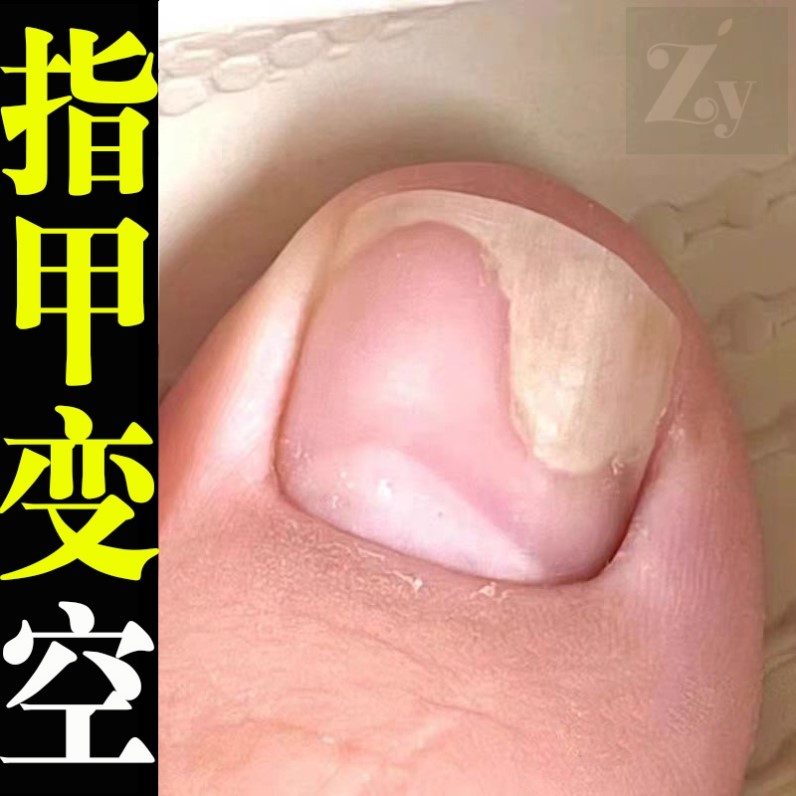 指甲变空心甲床甲肉分离修复营养液受损游离线生长液凹凸保养护油