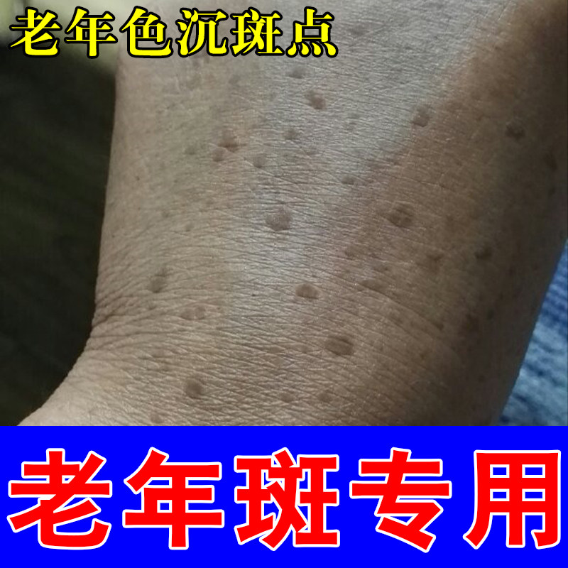 老人斑老年黑黄色斑点斑黄斑手部脸部皮肤暗沉修护白均匀膏乳