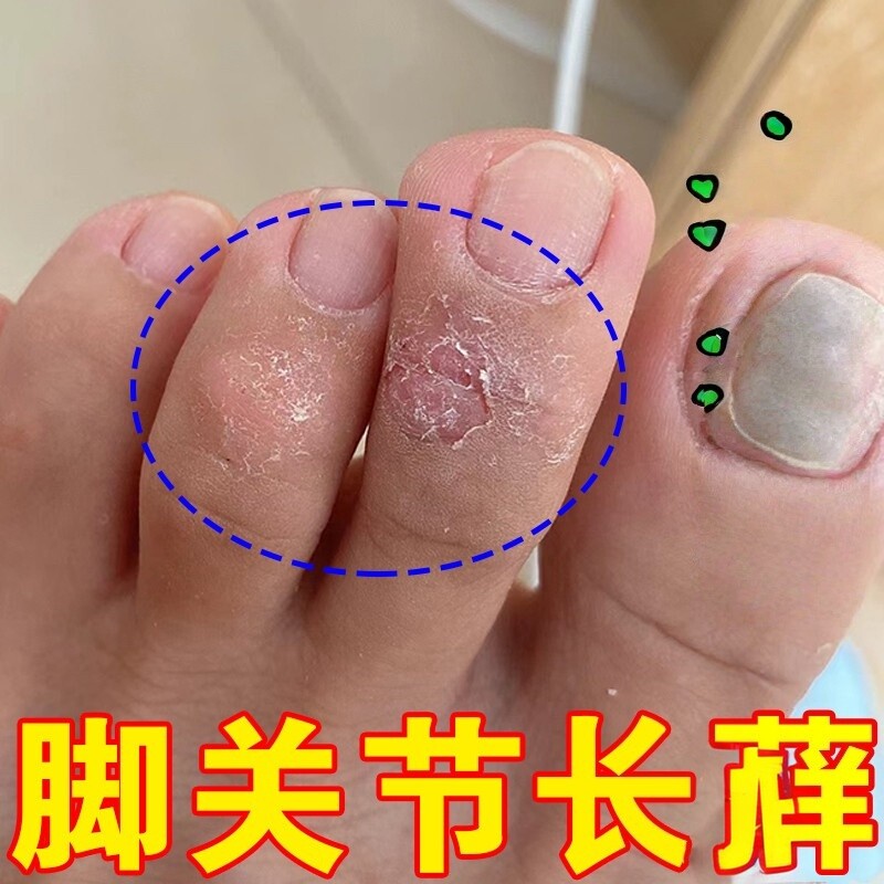 脚趾关节痒脚指头干燥脚背上痒脚面越抓越痒足/痒皮/痒脚趾开裂