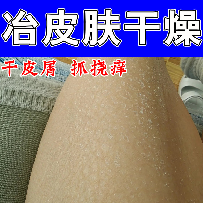 腿上干燥起皮小腿皮肤粗糙干裂成人身上掉皮屑起皮保湿甘油