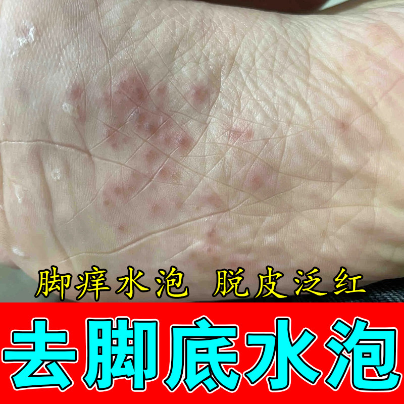 脚底密集小水泡干痒蜕皮难忍起皮干燥粗糙角质层增厚草本软膏
