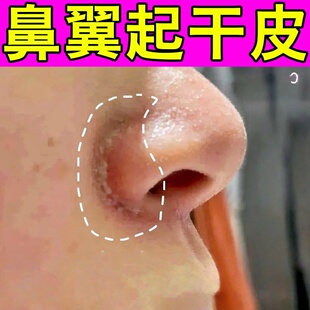 鼻子两侧发红脱皮痒鼻翼两边泛红干燥起皮掉皮脂溢性皮痒专用膏