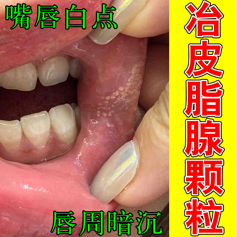皮脂腺异位嘴唇干裂起泡唇部长脂肪粒小白点嘴巴暗沉长白斑保湿膏