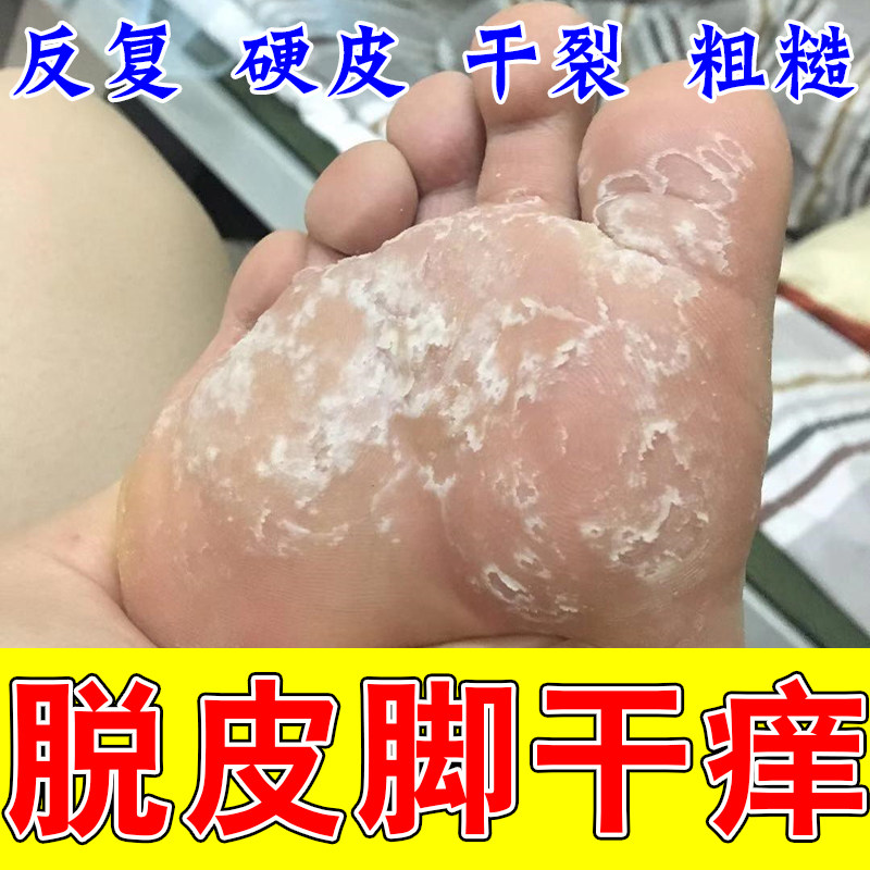 改善足脱皮膏手指上起皮干燥手掌严重蜕皮儿童手脚掉皮专用膏