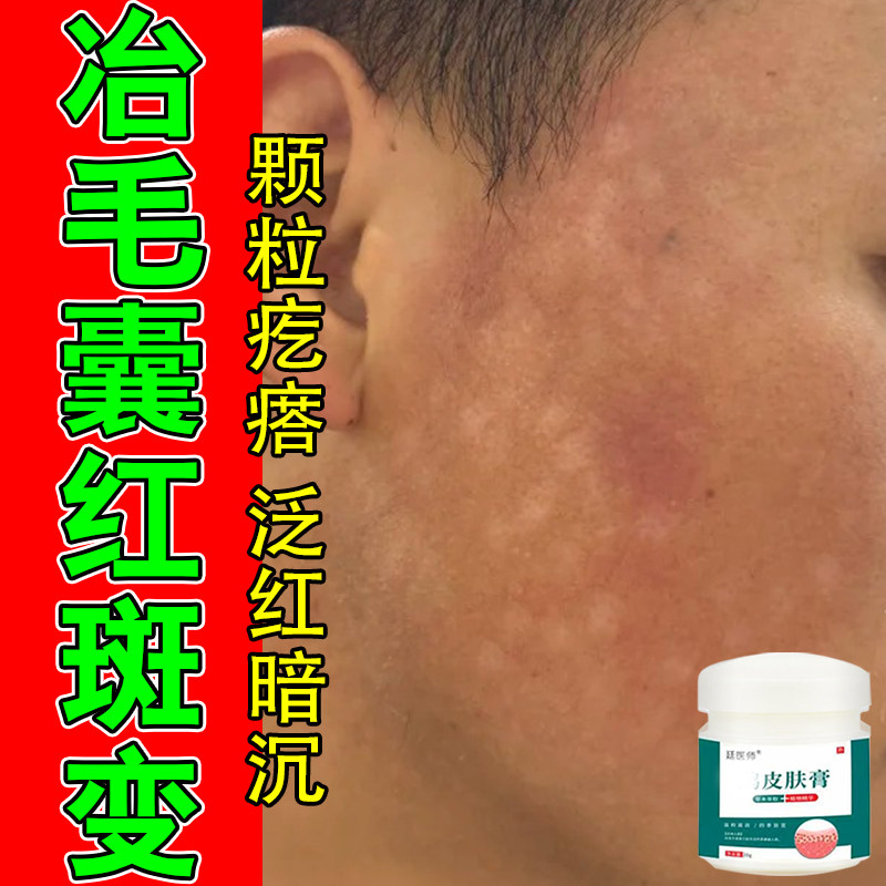 面颊毛囊红斑黑变角质疙瘩色素堆积暗沉脸部泛红黑粗糙草本修护膏