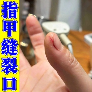 指甲缝手指头裂口子干裂修复霜手指尖开裂疼痛防脱皮愈合液