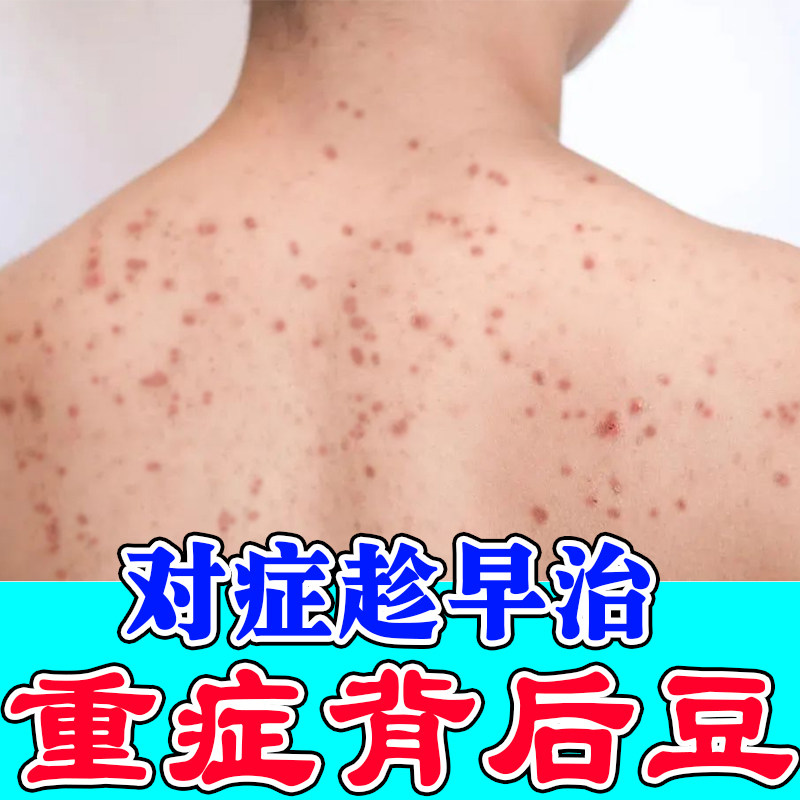 后背去痘去后背胸口身上长除螨虫消淡痘坑印马拉色菌毛囊膏