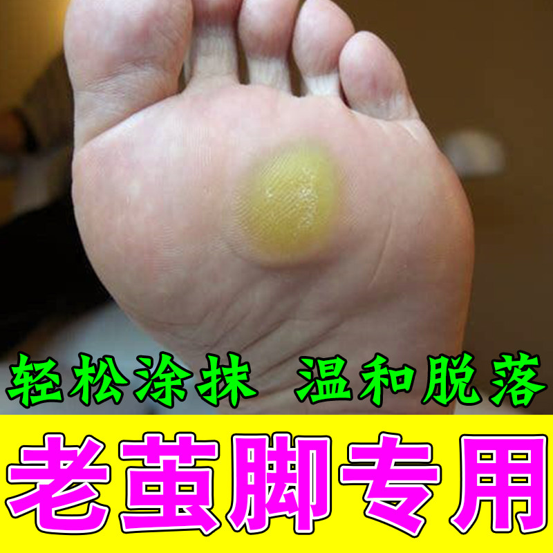 脚茧子皮肤粗糙发硬脚底老茧指关节粗硬死皮草本角质软化贴