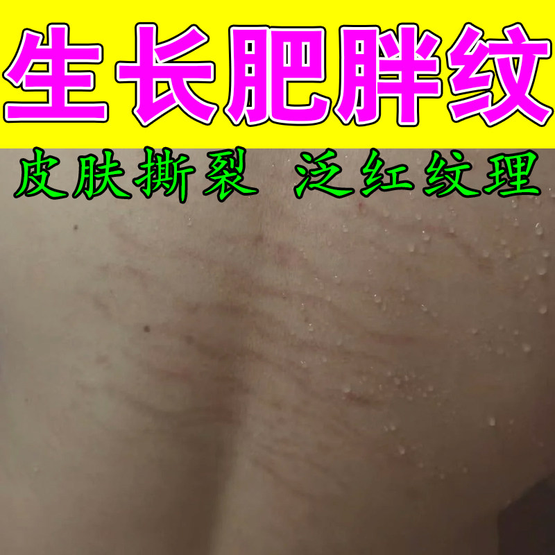 肥胖纹淡化青少年学生大腿生长纹屁股上长肥胖纹淡纹修复膏