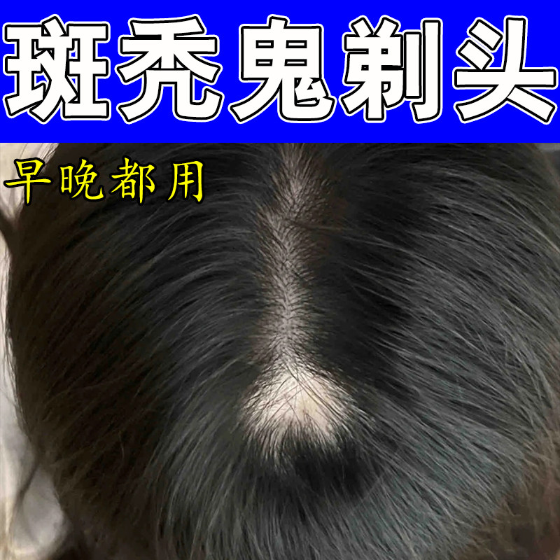 斑秃头裸露头顶大把掉发后脑勺光秃滋养发根激活毛囊修护草本喷剂