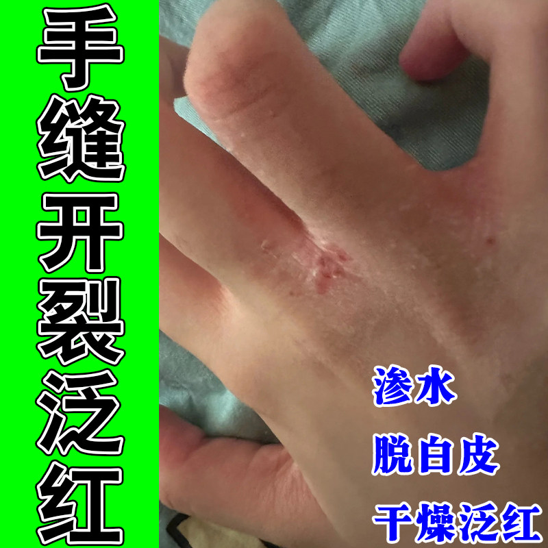 手指缝痒手指间起皮经常碰水起皮手丫膏脱皮真菌草本保湿膏