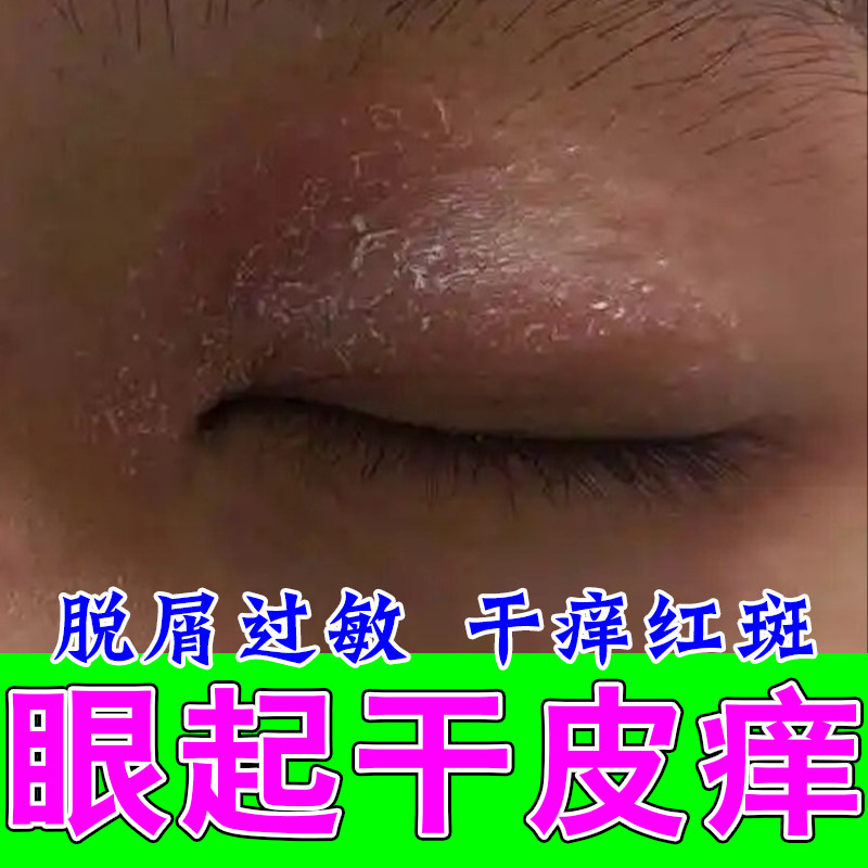 眼皮神经性过敏眼皮红肿痒眼周泛红发痒眼角干燥起皮屑修护植物膏