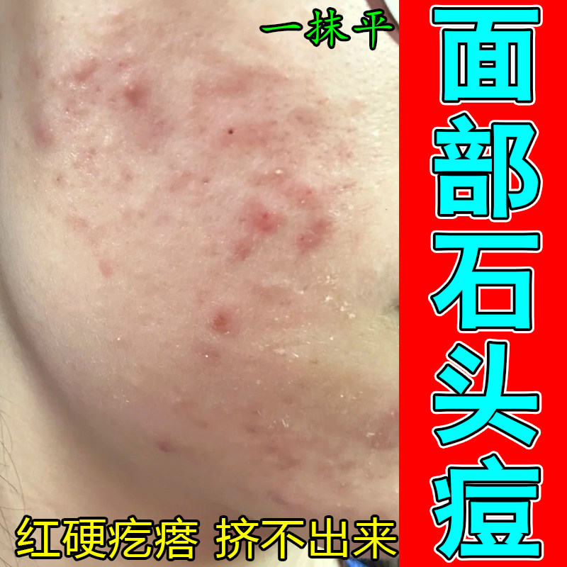 冶脸上长痘红肿硬块起皮干燥成人粉刺疙瘩修护草本保湿乳霜