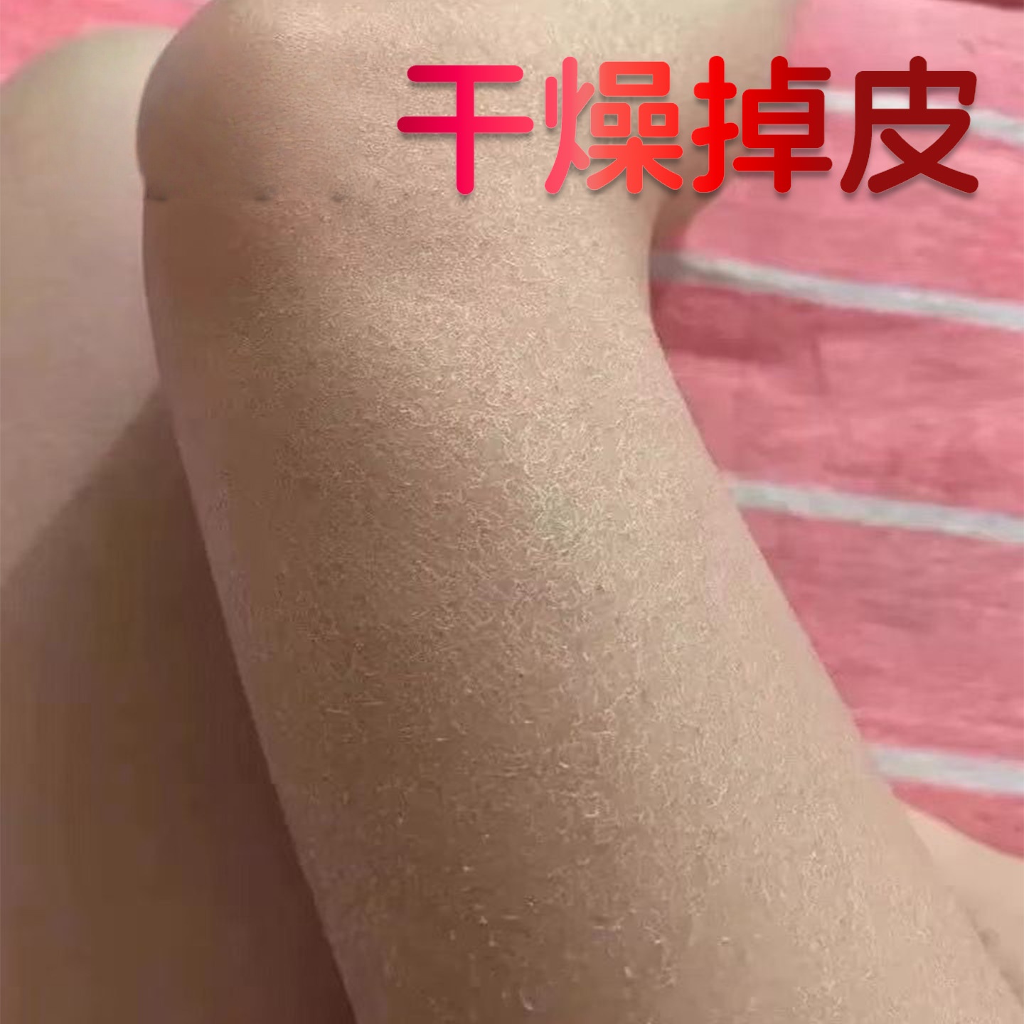 鱼鳞皮肤霜专用膏去鸡蛇皮肤腿部干燥起皮痒掉皮屑护理身体乳液