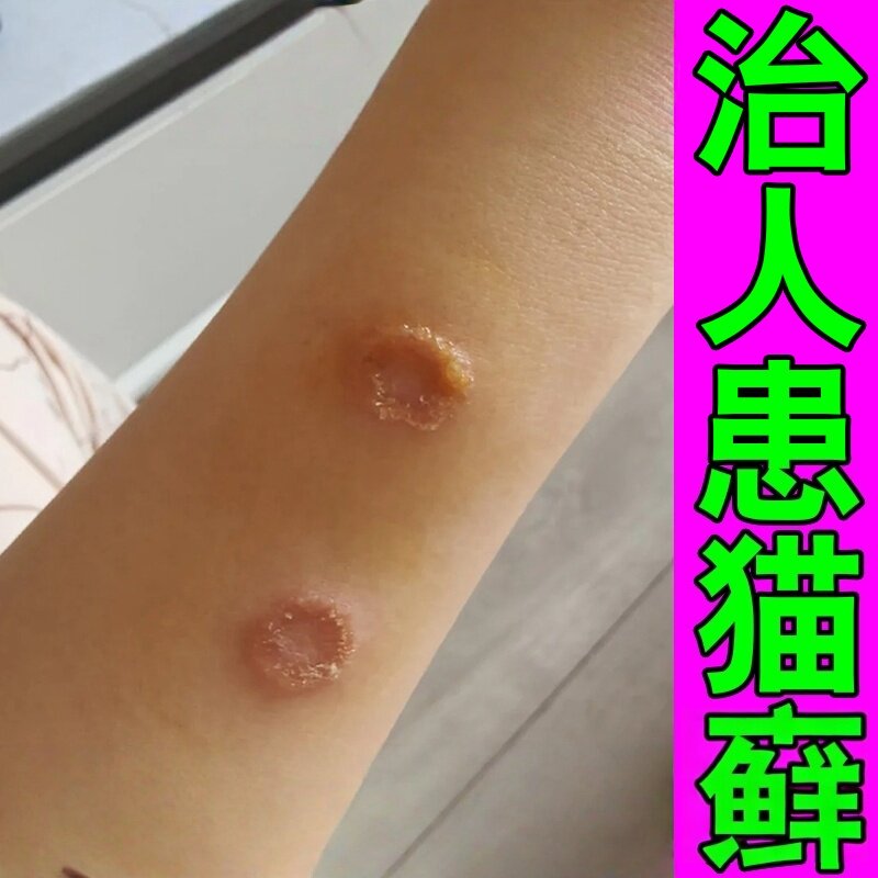 人用猫痒膏去除猫痒外用膏人得了猫痒皮肤真菌痒红斑水疱湿红诊膏