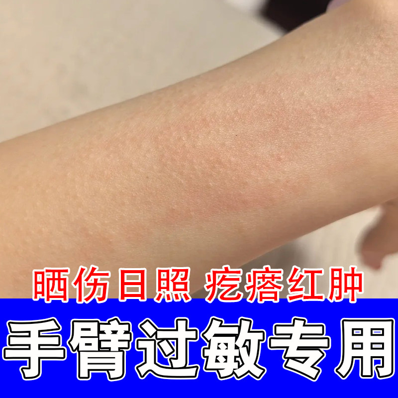 日光性敏感紫外线诱发起疙瘩肿痛泛红太阳灼伤皮肤发痒舒缓修护膏