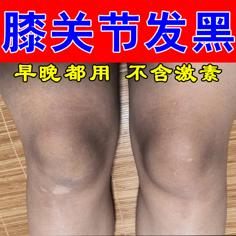 膝盖变黑干燥暗沉发黑摩擦粗糙干燥舒缓黑棘皮粗糙肌肤按摩膏