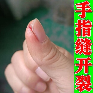 指甲缝开裂手指头裂口子干裂修复霜秋冬季防裂手足裂脱皮专用膏