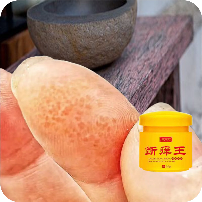 手上长透明小泡痒汗诊手背痒湿/手指缝长水泡溃烂痒诊