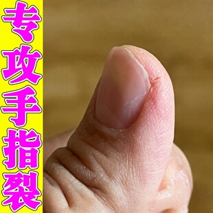 手指脱皮干裂修复霜秋冬季指甲缝干裂口蜕皮严重感染真菌膏