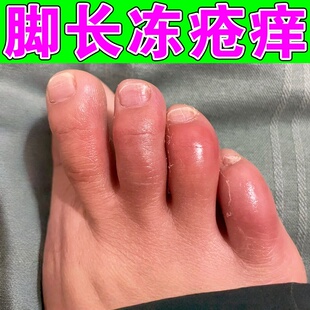 脚指头长冻疮红肿痒冬天手足耳朵防冻伤手指干裂脱皮防冻裂护手霜