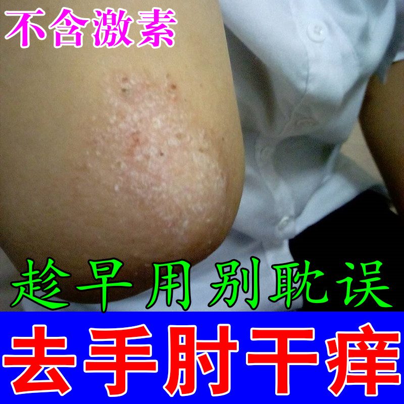 胳膊肘红屑胳膊肘关节发肤红干燥粗糙脱皮掉屑角质皮肤神经过敏痒