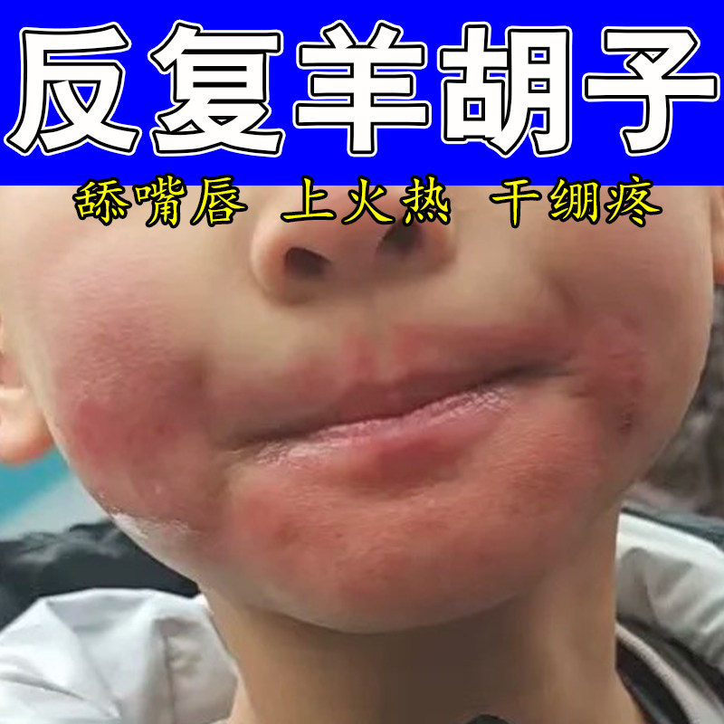 羊胡子舔嘴口周泛红结痂干疼起皮粗糙不适肿疼干燥结痂疼修护膏
