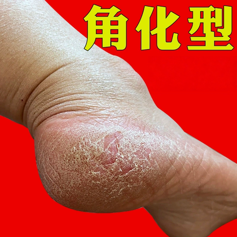 角化型足jiao气后脚跟增厚干裂脱皮小泡感染真菌足/痒止喷剂痒