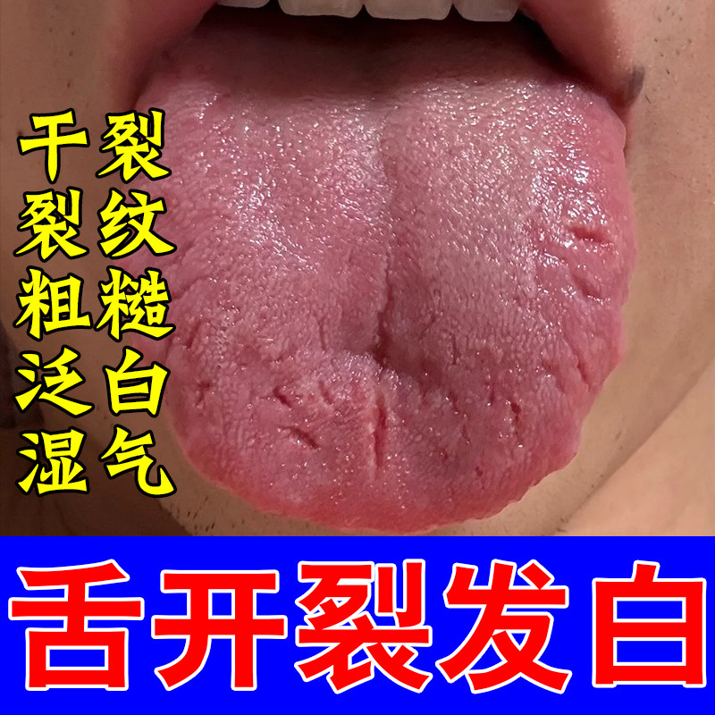 舌裂纹舌苔中间有裂痕舌苔白厚舌头裂纹舌头灼痛有齿痕喷雾剂