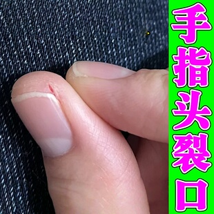 手指头裂口子干裂脱皮秋冬天指甲缝开裂疼痛干燥起硬皮愈合修复霜