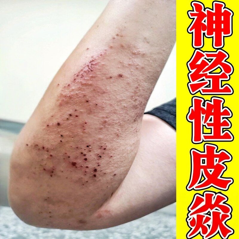 冶神经性焱手臂上长痒红斑疙瘩皮肤诊/湿过敏刺挠感真菌