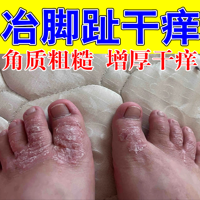 脚趾粗糙红疙瘩痒修护膏草本保湿软化脚趾关节厚皮草本修护软膏