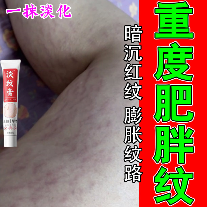 去肥胖纹生长纹修复膏淡化大腿学生腰腹上肥胖纹去男女通用膏