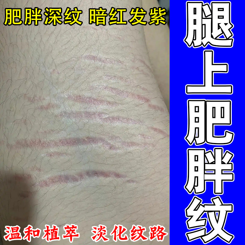 去腿上肥胖纹生长纹修复膏淡化学生大腿屁股肥胖纹路淡化修复膏