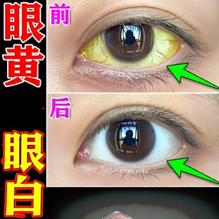 眼白发黄眼睛清澈黄浑浊修复滴眼液治眼底黄眼药水
