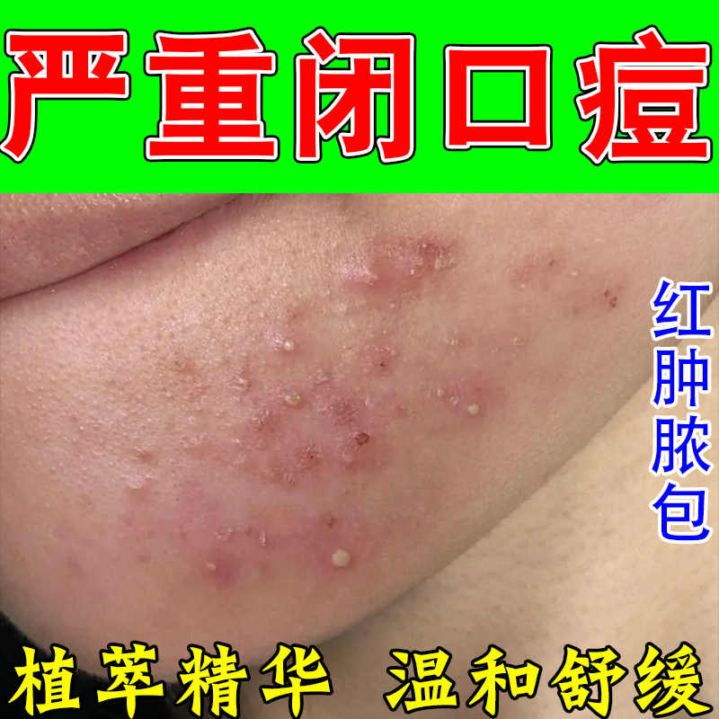 去闭口粉刺下巴脸部额头粉刺疙瘩多红肿疼密集疙瘩草本修护乳膏