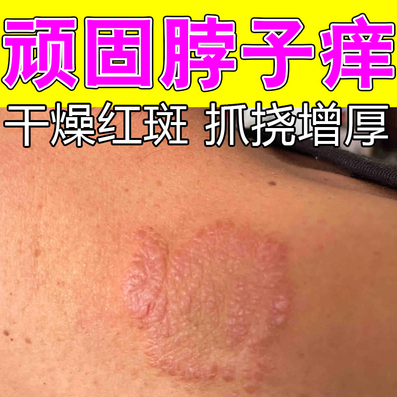 脖子后面脖圈红痒刺挠颈部上起红疙瘩过敏神经性皮肤修护草本软膏
