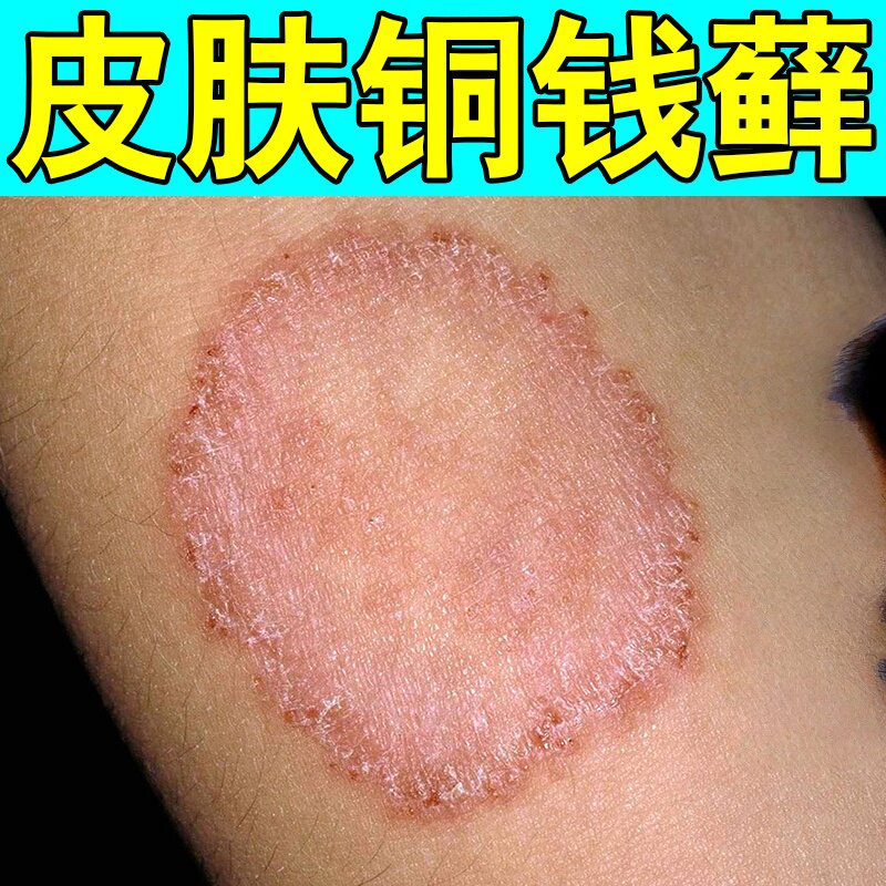 去铜钱痒体痒专用膏猫痒花斑痒身上痒鳞屑刺挠皮痒红斑外用