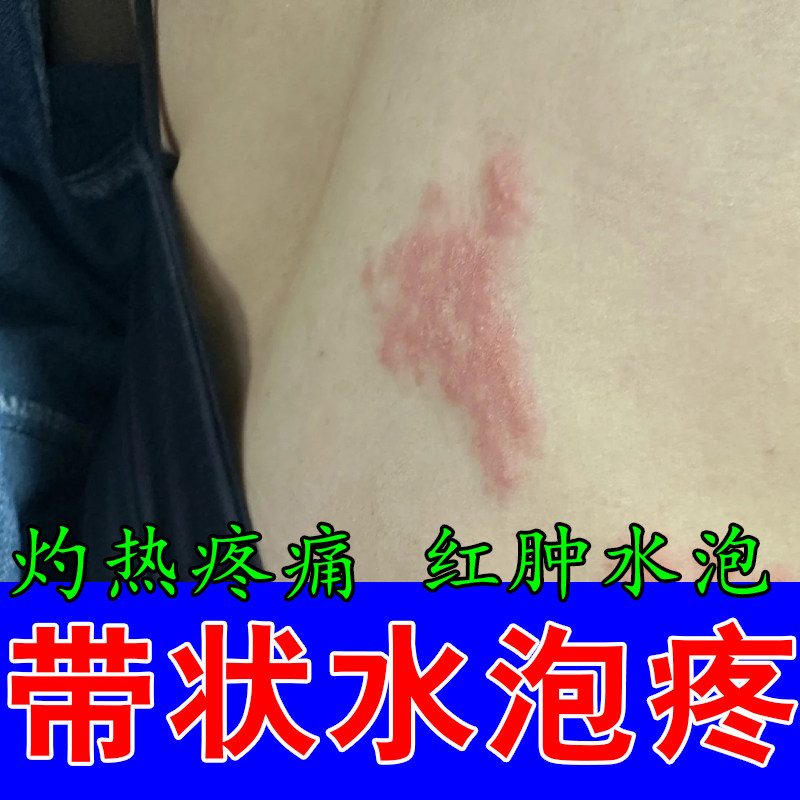 腰上长小疙瘩起泡小水红皮肤过敏真菌汗状泡皮肤红痛刺修护乳膏