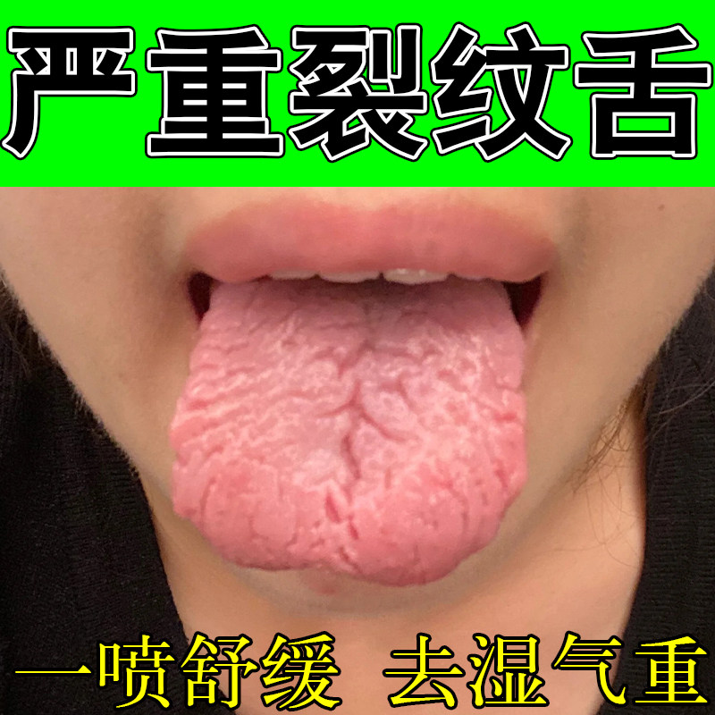 舌头有裂纹发热灼口口腔麻木舌面裂纹表面修护植物萃取喷剂