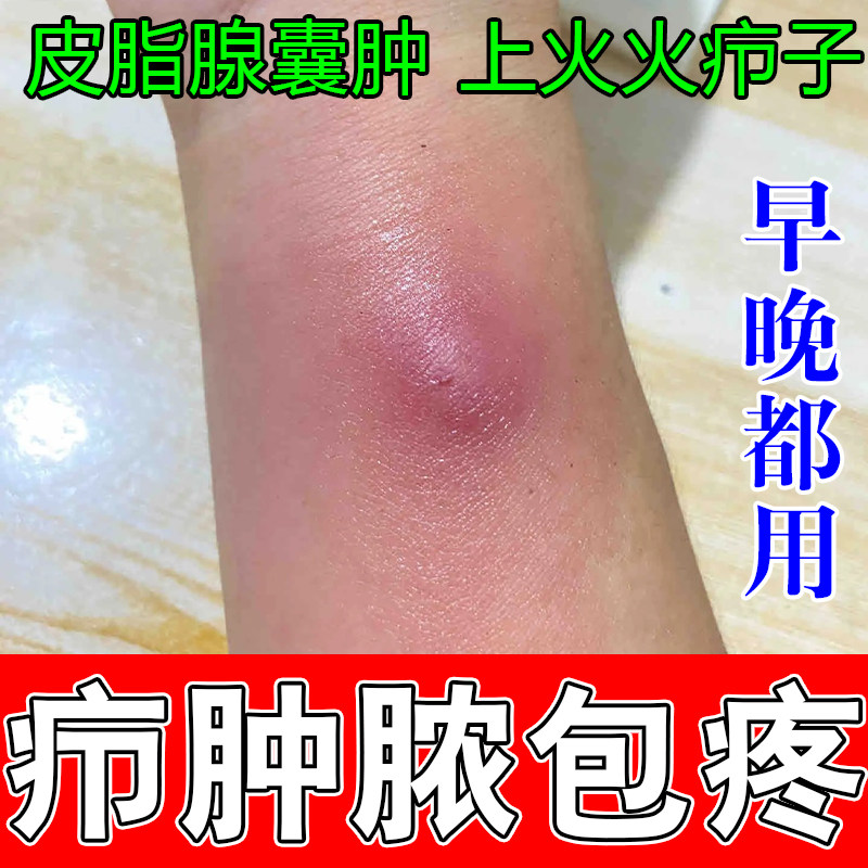 冶身上肿包疙瘩火疖子身上红疙瘩肿硬块脓包热火疖子修护草本膏